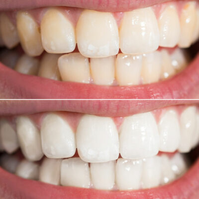 Effective Tips for Teeth Whitening