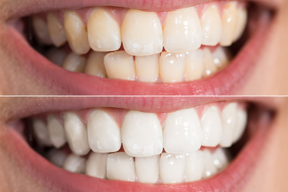 Effective Tips for Teeth Whitening