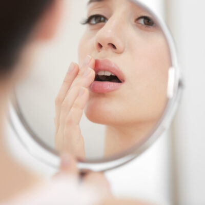 Tips to Prevent Cold Sores