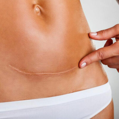 5 Early Symptoms for Ovarian Cancer