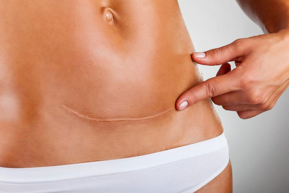 5 Early Symptoms for Ovarian Cancer
