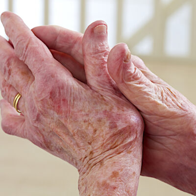 The Early Warning Signs of Lupus