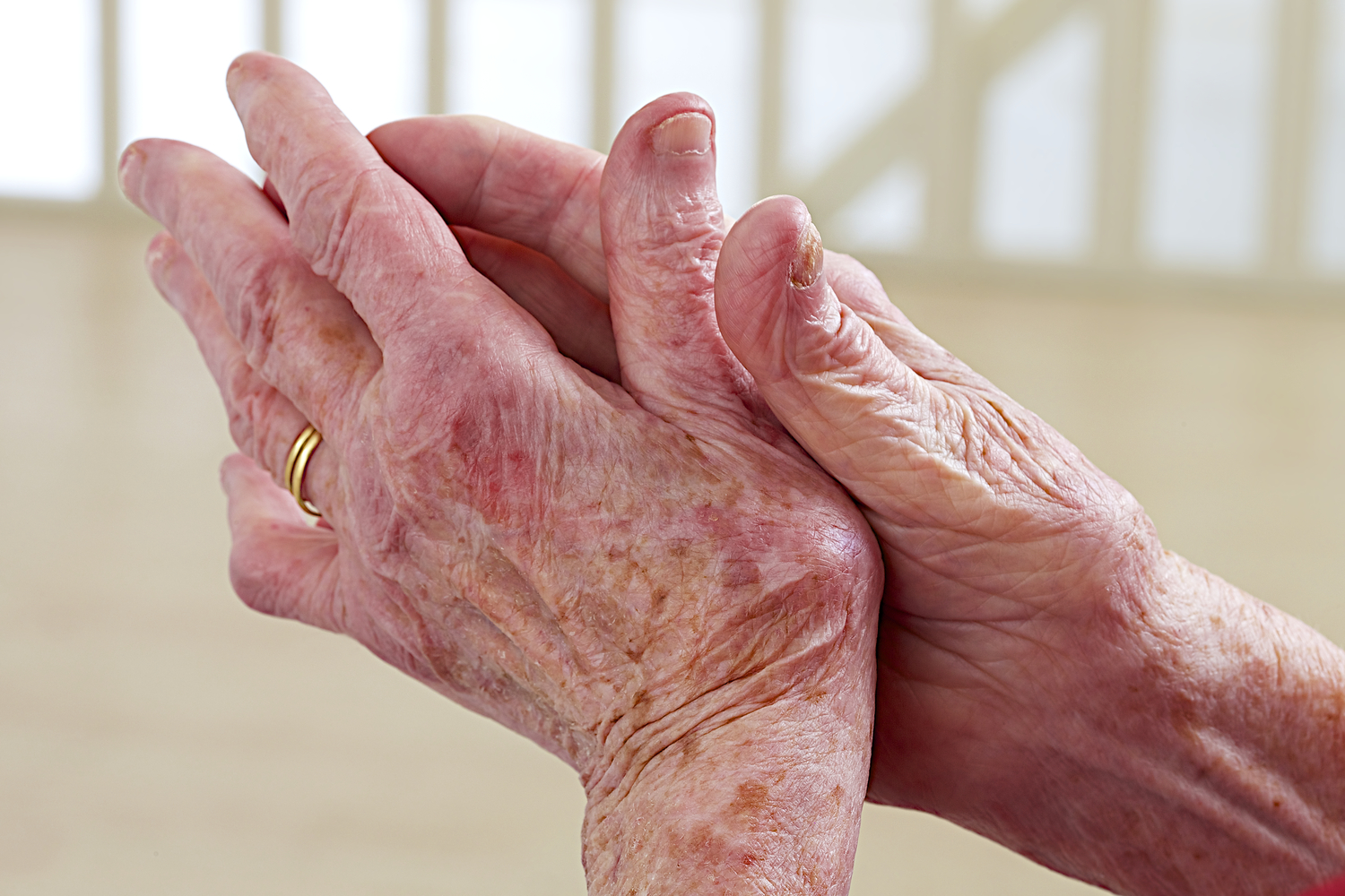 The Early Warning Signs of Lupus